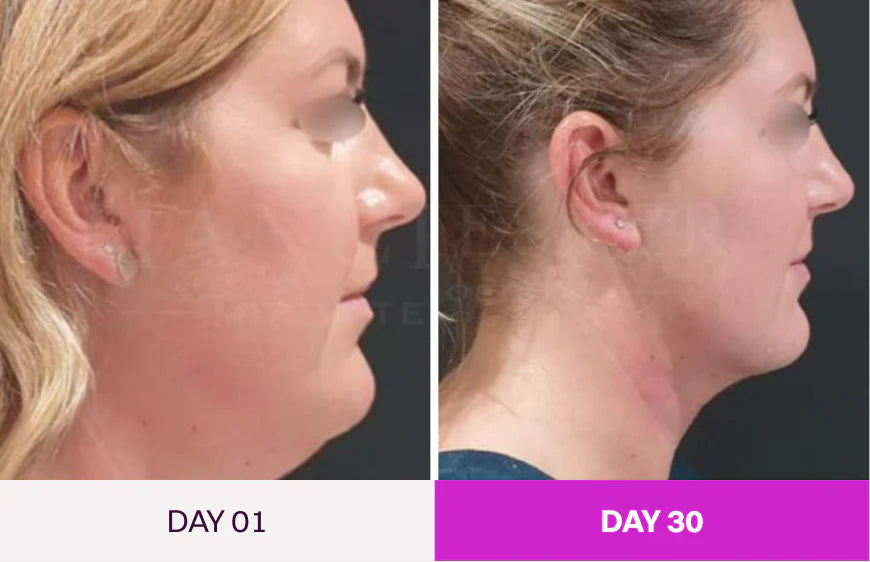 Before and After